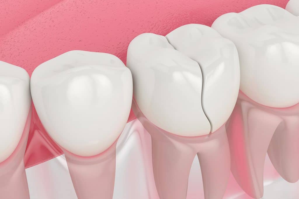 5 Signs You Cracked a Tooth