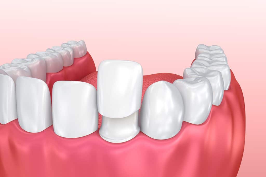 How Much Do Veneers Cost in NYC?